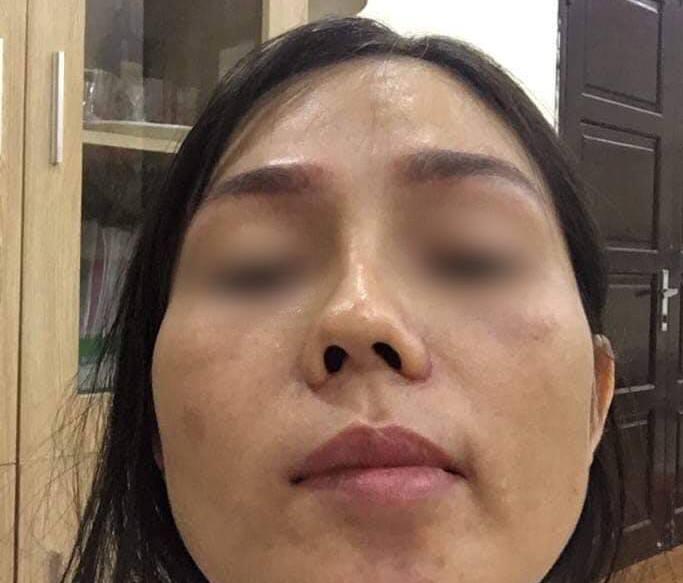 Biến chứng hậu phẫu thuật nâng mũi, cô gái bị áp xe đến lòi cả sụn-7