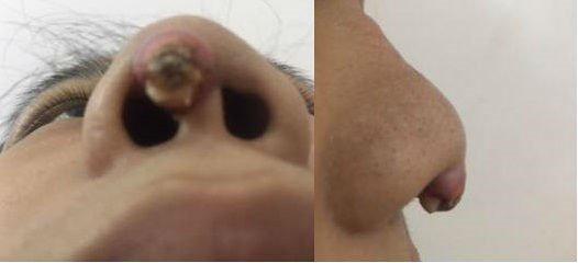 Biến chứng hậu phẫu thuật nâng mũi, cô gái bị áp xe đến lòi cả sụn-9