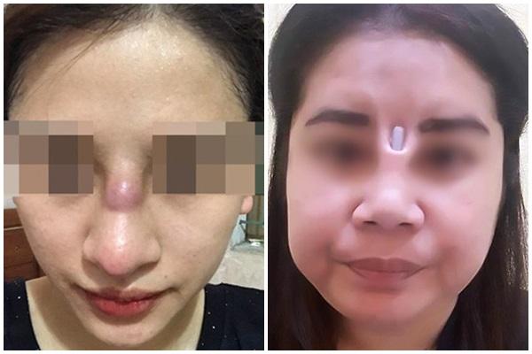 Cô gái toang mũi vì phẫu thuật hỏng, mổ đi mổ lại đến 4 lần-4