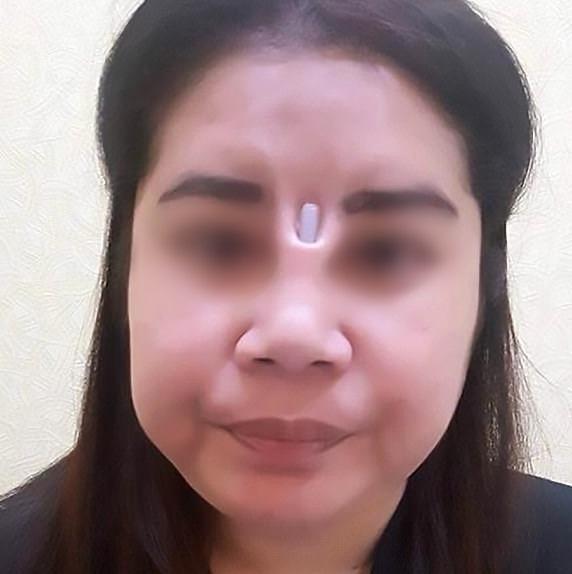 Biến chứng hậu phẫu thuật nâng mũi, cô gái bị áp xe đến lòi cả sụn-2