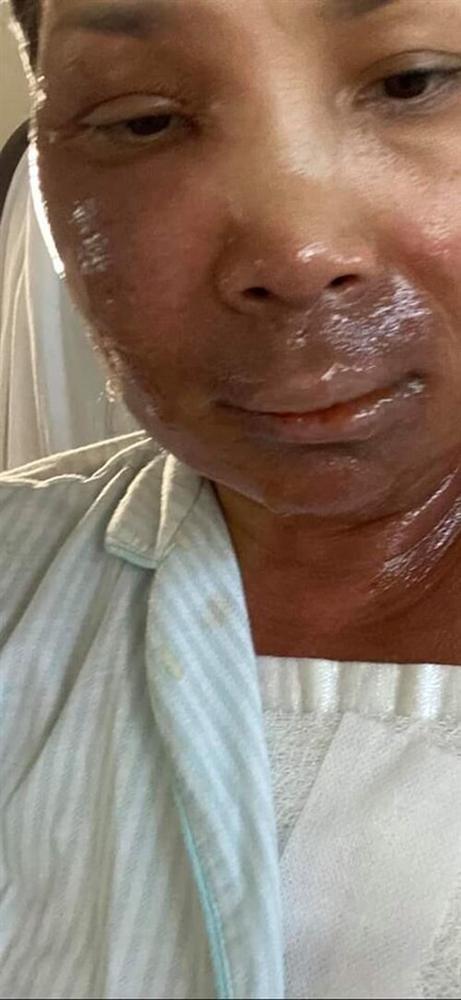 Hồng Ngọc khoe cận nhan sắc rạng rỡ sau bỏng nặng, lộ ra một số thương tích khó lành-1