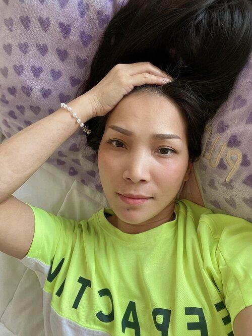 Hồng Ngọc khoe cận nhan sắc rạng rỡ sau bỏng nặng, lộ ra một số thương tích khó lành-4