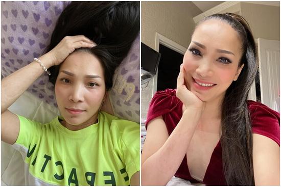 Hồng Ngọc khoe cận nhan sắc rạng rỡ sau bỏng nặng, lộ ra một số thương tích khó lành