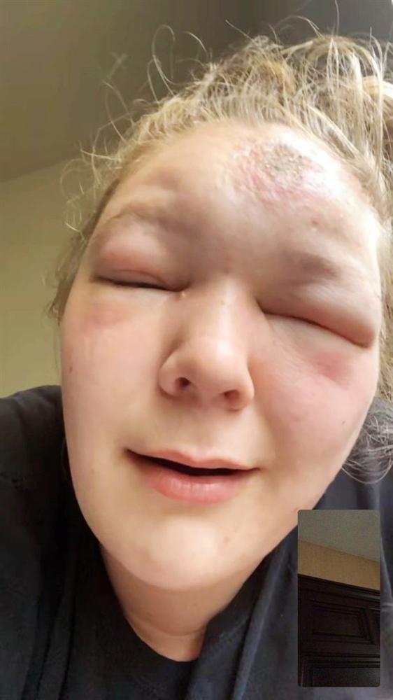 9X bị sưng phồng mắt, mù tạm thời sau 2 tiếng phơi nắng-2