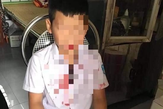 Học sinh lớp 1 bị bố của bạn hành hung chảy máu đầu