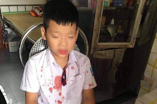 Vợ kẻ hành hung bé trai lớp 1: Chồng tôi chỉ tát cháu sưng mồm thôi...-1