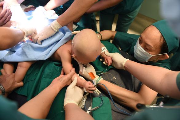 Full hình ảnh từ phút sinh ra đến ca đại phẫu sinh tử của 2 bé song sinh dính liền cơ thể-13