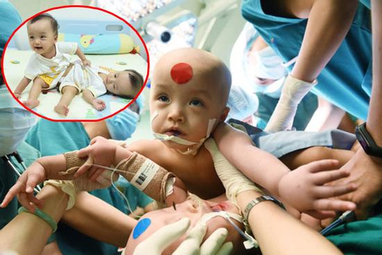 Bắt đầu ca đại phẫu 'cân não' kéo dài 12 giờ tách rời cặp song sinh phức tạp nhất Việt Nam