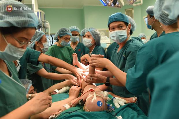 Full hình ảnh từ phút sinh ra đến ca đại phẫu sinh tử của 2 bé song sinh dính liền cơ thể-18