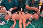 Cập nhật: Hình ảnh từ phòng đại phẫu 'sinh tử', tách 2 bé dính nhau khó nhất Việt Nam