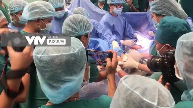 8 tiếng phẫu thuật liên tục, cặp song sinh dính liền được tách rời thành công-1