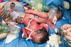 Full hình ảnh từ phút sinh ra đến ca đại phẫu sinh tử của 2 bé song sinh dính liền cơ thể