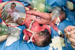 Full hình ảnh từ phút sinh ra đến ca đại phẫu sinh tử của 2 bé song sinh dính liền cơ thể