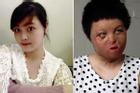 Lần phẫu thuật thứ 17 của cô gái Hà Nội bị chồng tưới xăng thiêu sống