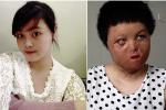 Lần phẫu thuật thứ 17 của cô gái Hà Nội bị chồng tưới xăng thiêu sống