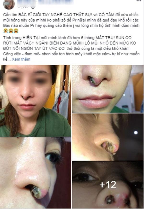 Cô gái toang mũi vì phẫu thuật hỏng, mổ đi mổ lại đến 4 lần-2