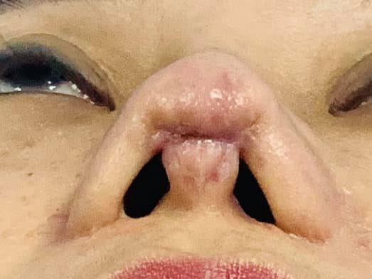 Cô gái toang mũi vì phẫu thuật hỏng, mổ đi mổ lại đến 4 lần-1