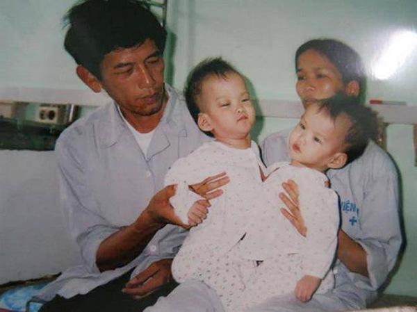 Cặp song sinh dính liền nổi tiếng Cúc - An thay đổi bất ngờ sau 17 năm phẫu thuật tách rời-1