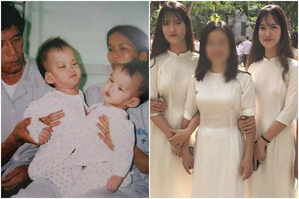 Cặp song sinh dính liền đầu tiên ở Việt Nam sống thế nào sau 33 năm phẫu thuật?-10