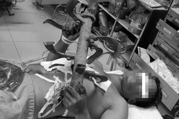 Bác sĩ hốt hoảng khi bệnh nhân vào viện hai tay ôm máy cày trước ngực-1