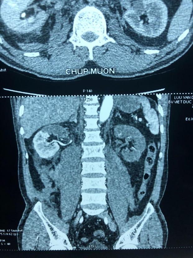 Hà Nội: Cắt thận ra rửa rồi ghép lại cứu sống bệnh nhân một cách ngoạn mục-1