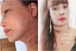 Hơn 1 tháng sau dao kéo, gương mặt cô dâu 63 tuổi ở Cao Bằng vẫn méo lệch-8