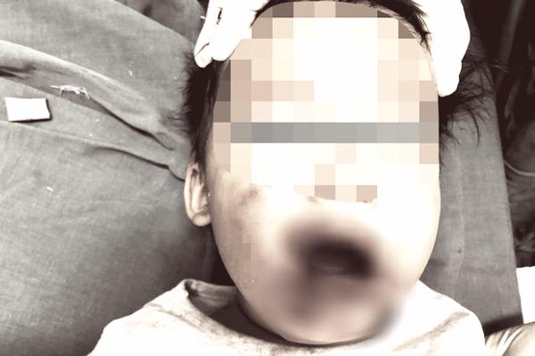 Cắn dây điện, bé gái 2 tuổi bất tỉnh, cằm miệng hoại tử-1