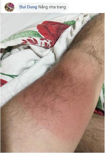 Dưỡng trắng 3 năm, cháy 1 giờ của những con giời trở về sau mùa du lịch-3