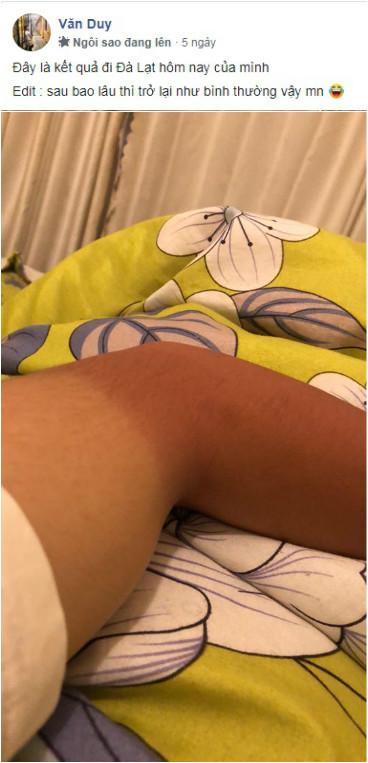 Dưỡng trắng 3 năm, cháy 1 giờ của những con giời trở về sau mùa du lịch-5