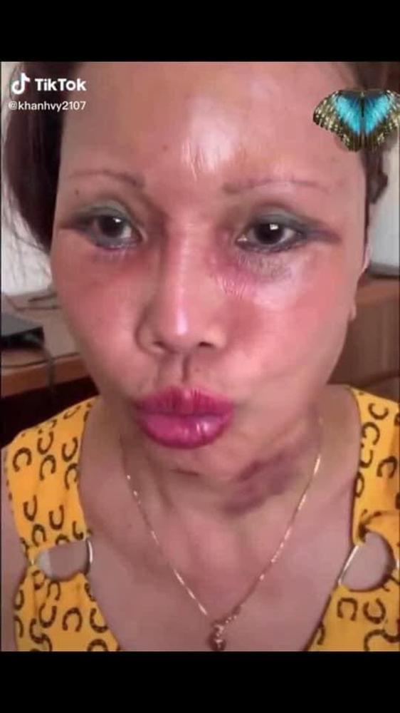 Hơn 1 tháng sau dao kéo, gương mặt cô dâu 63 tuổi ở Cao Bằng vẫn méo lệch-7