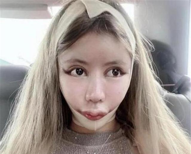 Cô gái phẫu thuật thẩm mỹ từ năm 13 tuổi, 3 năm 60 lần dao kéo giờ ra sao?-3