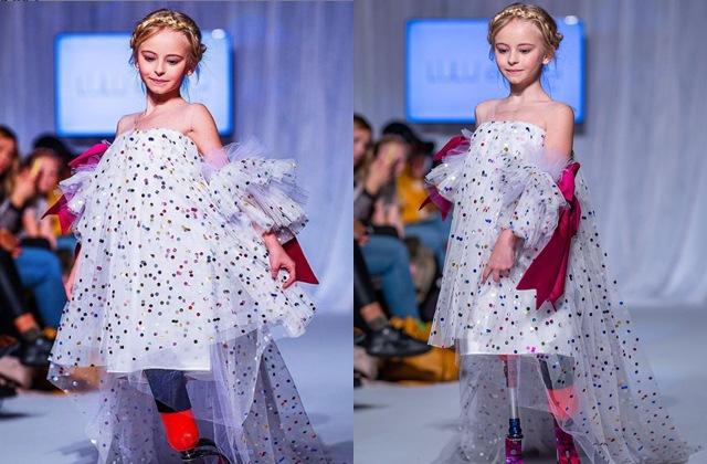 Bé gái sinh ra với chân 5cm, 18 tháng phải cắt cụt chân, sau 10 năm trở thành hiện tượng-2