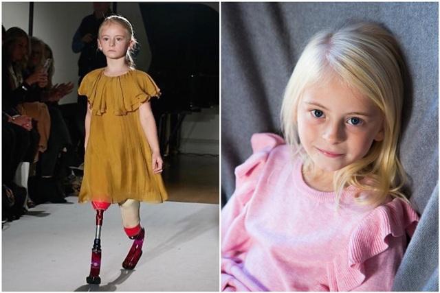 Bé gái sinh ra với chân 5cm, 18 tháng phải cắt cụt chân, sau 10 năm trở thành hiện tượng-3