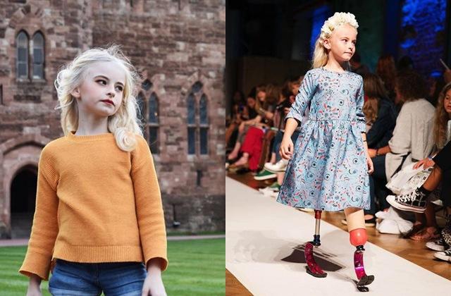 Bé gái sinh ra với chân 5cm, 18 tháng phải cắt cụt chân, sau 10 năm trở thành hiện tượng-4