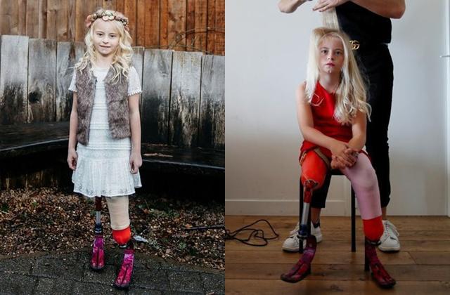 Bé gái sinh ra với chân 5cm, 18 tháng phải cắt cụt chân, sau 10 năm trở thành hiện tượng-5