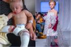 Bé gái sinh ra với chân 5cm, 18 tháng phải cắt cụt chân, sau 10 năm trở thành hiện tượng