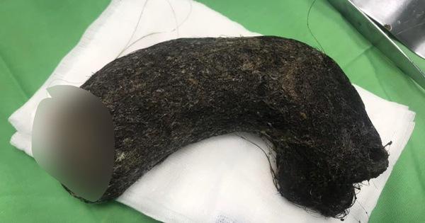Sợ hãi búi tóc nặng 1kg lấy ra từ dạ dày bé gái 11 tuổi ở Nghệ An-2