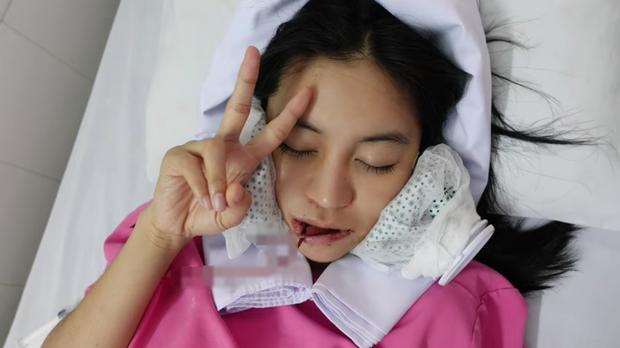 Hot girl Trang Anna bổ sung ca phẫu thuật hạ gò má vào bộ sưu tập đập mặt xây lại-1