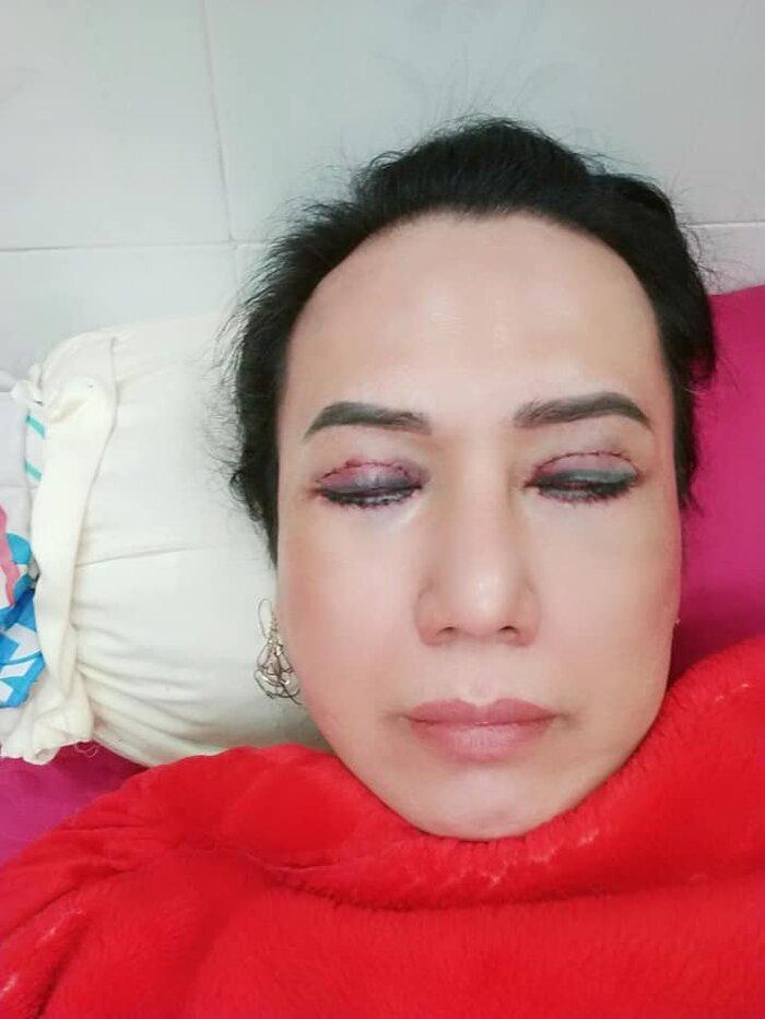 Cô Minh Hiếu khiến dân tình xôn xao khi công khai hình ảnh phẫu thuật thẩm mỹ-3