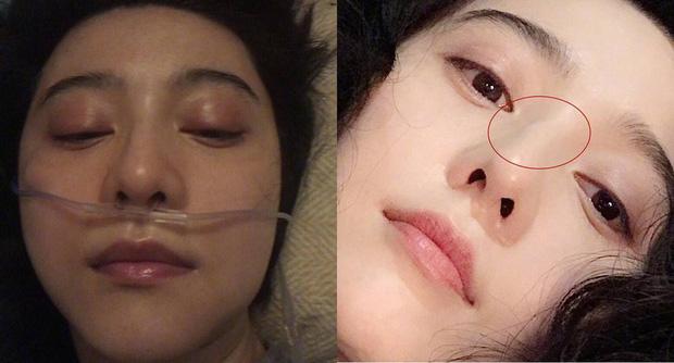 Phạm Băng Băng véo mũi nặn mụn xóa tan nghi vấn phẫu thuật thẩm mỹ-1