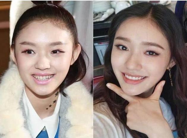 Giật mình với những hàm răng khấp khểnh kém duyên của sao Hoa ngữ-5