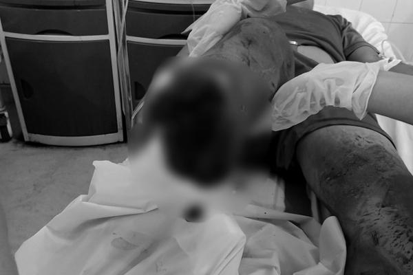 Kinh hãi: Thiếu nhiên 15 tuổi ở Tây Ninh bị chém đứt lìa chân, ướp đá mang đi cấp cứu-1