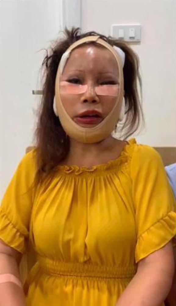 Tròn 2 tháng dao kéo, cô dâu Cao Bằng vẫn để lộ gương mặt méo lệch đáng thất vọng-1