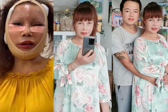 Tròn 2 tháng dao kéo, cô dâu Cao Bằng vẫn để lộ gương mặt méo lệch đáng thất vọng