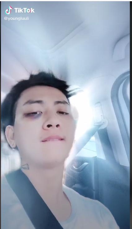 Rất lâu mới lộ diện, Hoài Lâm xuất hiện đôi mắt thâm tím như ẩu đả-2