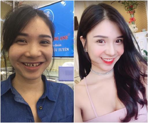 Công Phượng lộ bộ nhá tranh nhau làm tiền đạo trước khi niềng răng-12