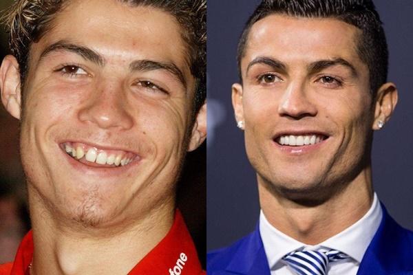 Công Phượng lộ bộ nhá tranh nhau làm tiền đạo trước khi niềng răng-5