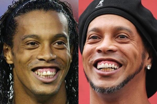 Công Phượng lộ bộ nhá tranh nhau làm tiền đạo trước khi niềng răng-7