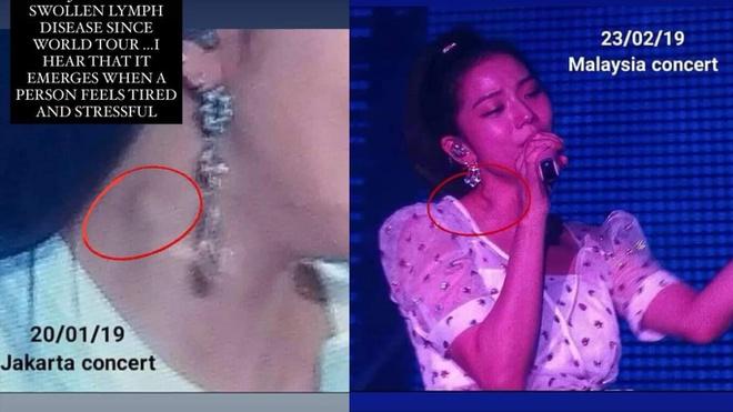 Hạch bạch huyết ở cổ Jisoo sưng to bất thường-2