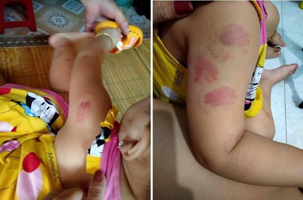 Đi học buổi thứ 2, bé gái về nhà với 12 vết tấy đỏ chi chít khắp người-1